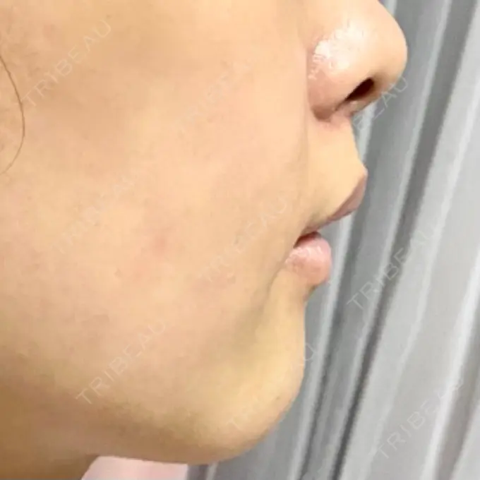 人中短縮 新宿ラクル美容外科クリニック 新宿院 DAY 51 メイン用