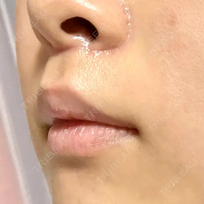 人中短縮 新宿ラクル美容外科クリニック 新宿院 DAY 51 メイン用