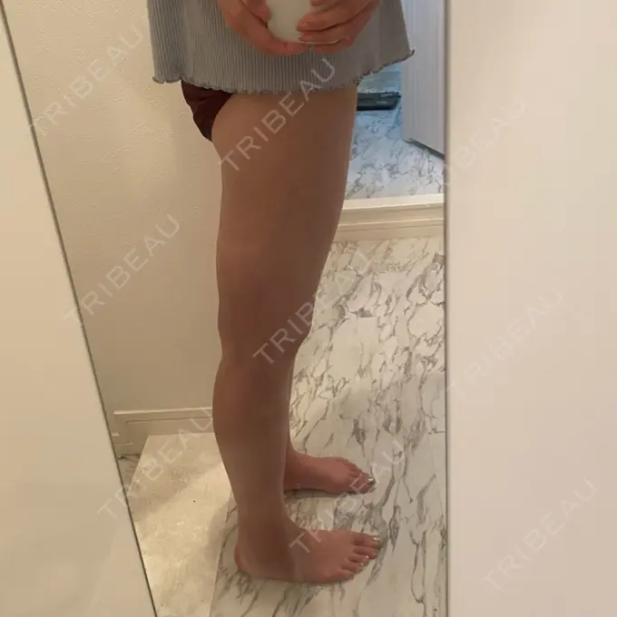 脂肪吸引（脚） THE CLINIC（ザ・クリニック） 福岡院 DAY 21 メイン用