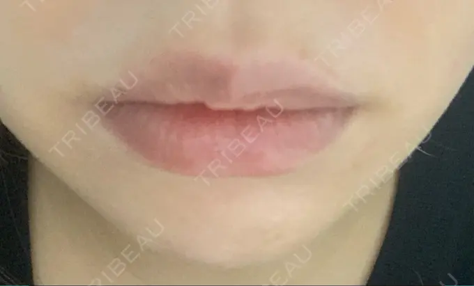 ヒアルロン酸注入（唇） / ボトックス（口角） id美容クリニック 銀座院 AFTER メイン用