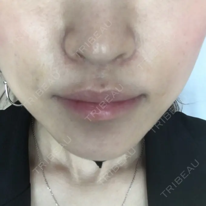 その他（輪郭） TCB東京中央美容外科 堺院 DAY 195 メイン用