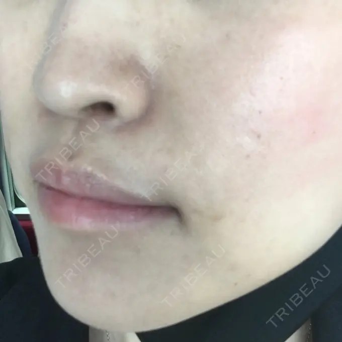 その他（輪郭） TCB東京中央美容外科 堺院 DAY 195 メイン用