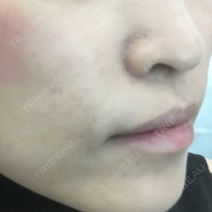 その他（輪郭） TCB東京中央美容外科 堺院 DAY 195 メイン用