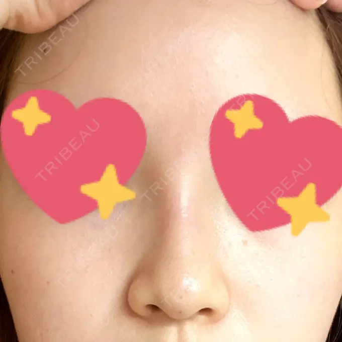 ヒアルロン酸注入（鼻） プライベートスキンクリニック 梅田本院 AFTER メイン用