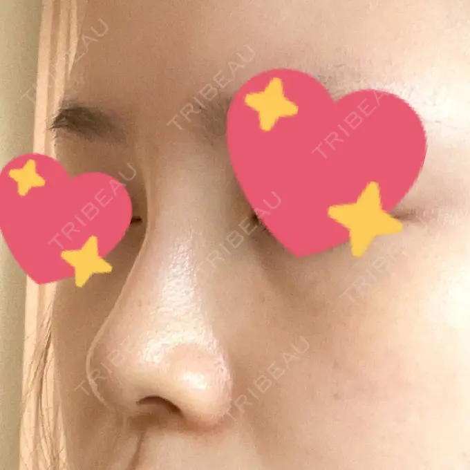 ヒアルロン酸注入（鼻） プライベートスキンクリニック 梅田本院 DAY 1 メイン用