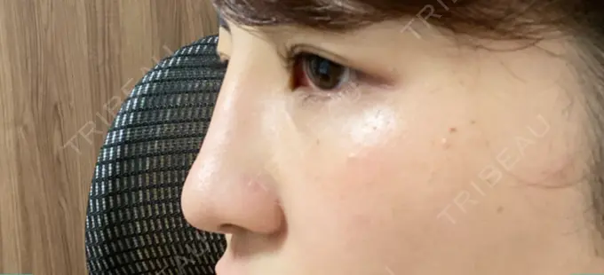 ヒアルロン酸注入（鼻） TCB東京中央美容外科 八王子院 AFTER メイン用