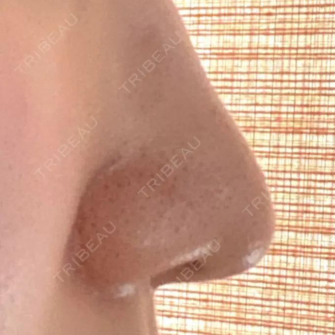 小鼻縮小（切開） 三輪皮フ科形成外科 DAY 174 メイン用