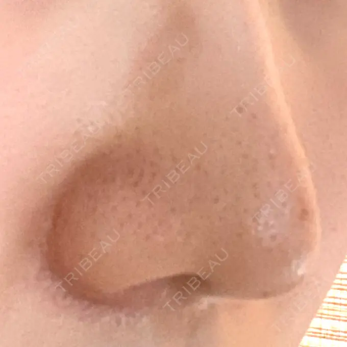 小鼻縮小（切開） 三輪皮フ科形成外科 DAY 174 メイン用