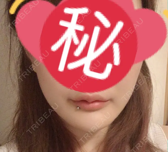 骨切り（あご） アーククリニック AFTER メイン用