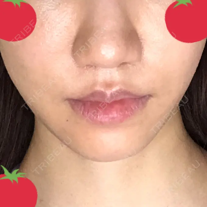 人中短縮 みずほクリニック DAY 34 メイン用