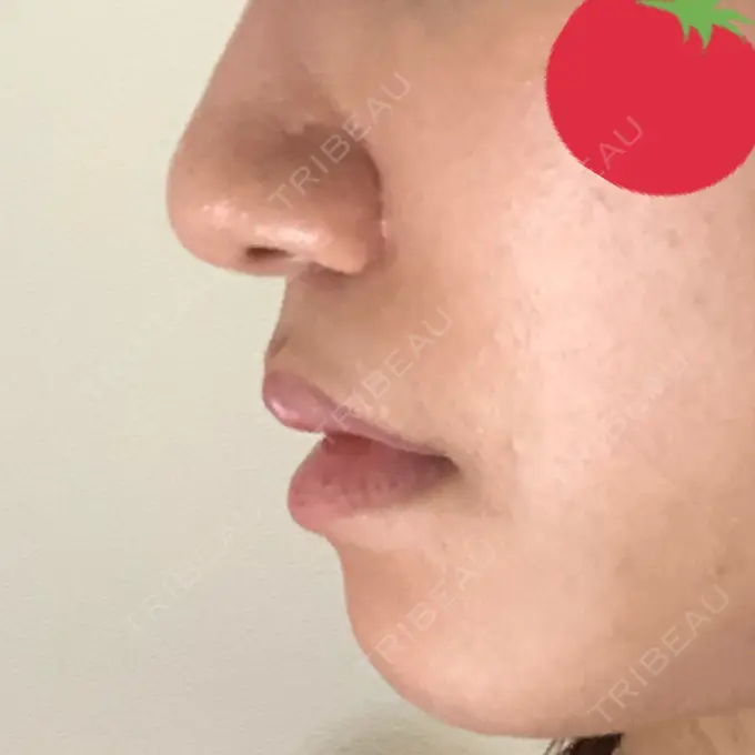 人中短縮 みずほクリニック DAY 34 メイン用