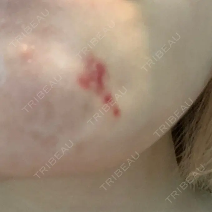 ほくろ・いぼ切除（肌） 新宿新南口れいわクリニック AFTER メイン用