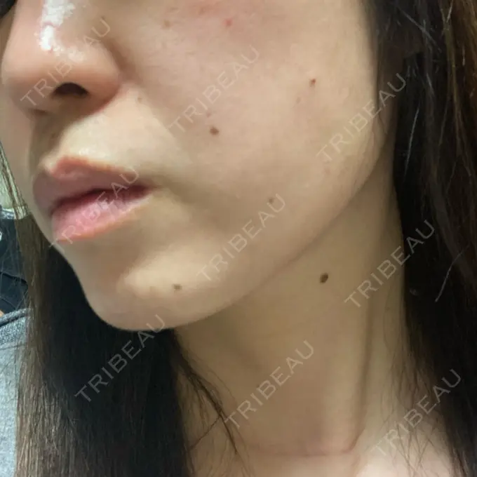 糸リフト / ボトックス（あご） TCB東京中央美容外科 千葉駅前院 DAY 52 メイン用