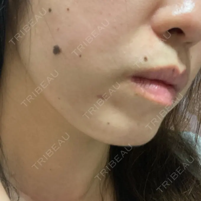 糸リフト / ボトックス（あご） TCB東京中央美容外科 千葉駅前院 DAY 52 メイン用