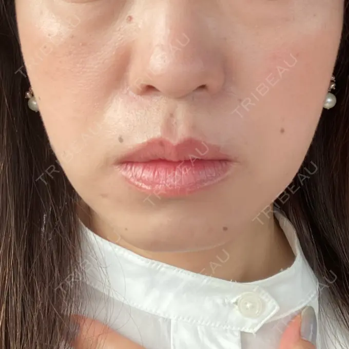 糸リフト / ボトックス（あご） TCB東京中央美容外科 千葉駅前院 DAY 77 メイン用