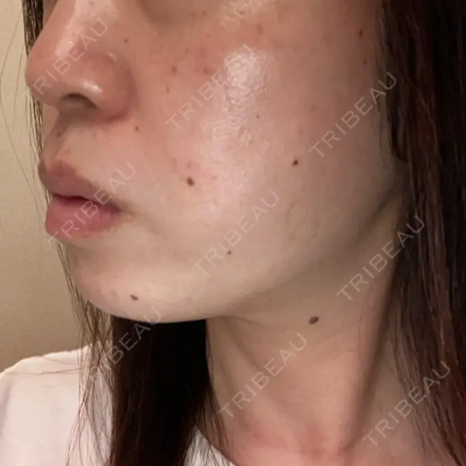 糸リフト / ボトックス（あご） TCB東京中央美容外科 千葉駅前院 DAY 106 メイン用