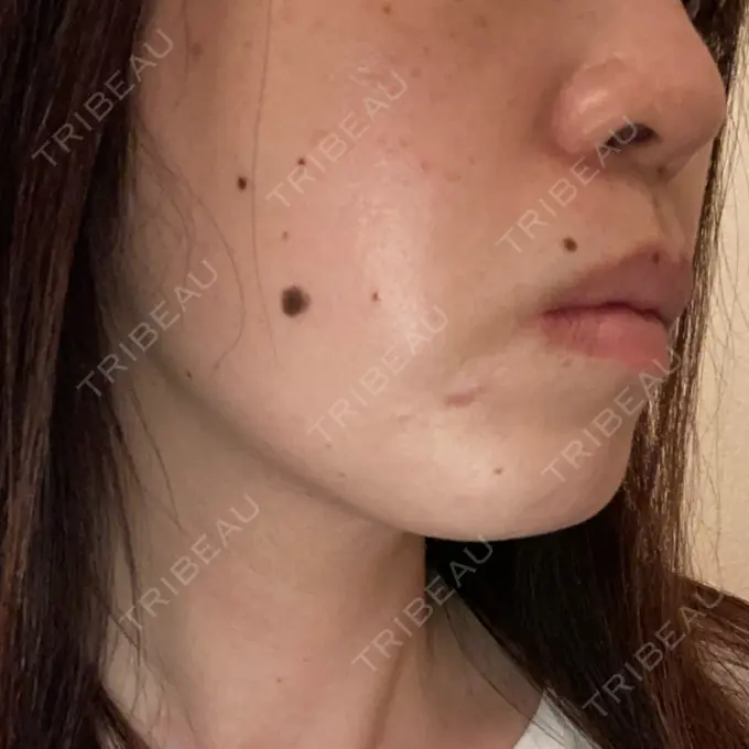 糸リフト / ボトックス（あご） TCB東京中央美容外科 千葉駅前院 DAY 106 メイン用