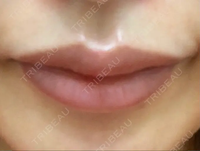 ヒアルロン酸注入（唇） / ボトックス（口角） id美容クリニック 銀座院 DAY 0 メイン用