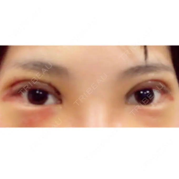 二重切開 共立美容外科 大分院 DAY 6 メイン用