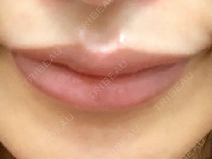 ヒアルロン酸注入（唇） / ボトックス（口角） id美容クリニック 銀座院 DAY 1 メイン用