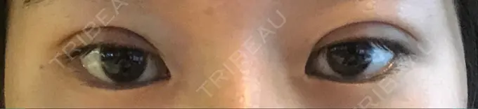 自然癒着法 マーブル美容整形外科 DAY 1 メイン用