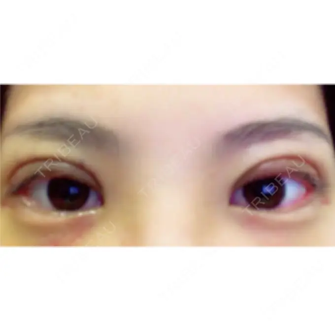 二重切開 共立美容外科 大分院 AFTER メイン用