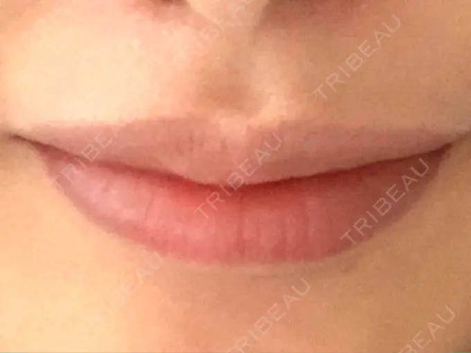ヒアルロン酸注入（唇） / ボトックス（口角） id美容クリニック 銀座院 AFTER メイン用