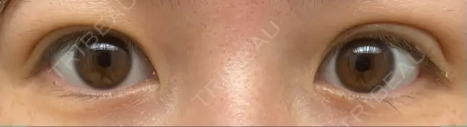 二重埋没 湘南美容クリニック 東京蒲田院 DAY 21 メイン用