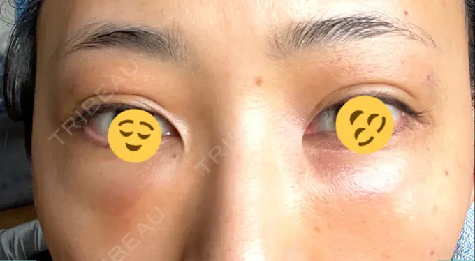 二重埋没 / クマ治療 / 上まぶたたるみ取り / 下まぶたたるみ取り MIL CLINIC OSAKA DAY 1 メイン用