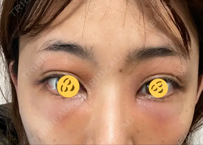 二重埋没 / クマ治療 / 上まぶたたるみ取り / 下まぶたたるみ取り MIL CLINIC OSAKA DAY 1 メイン用