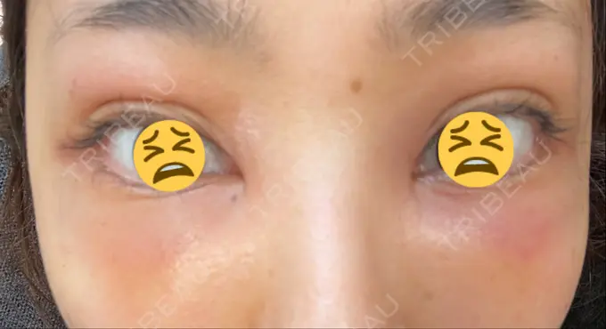 二重埋没 / クマ治療 / 上まぶたたるみ取り / 下まぶたたるみ取り MIL CLINIC OSAKA DAY 2 メイン用