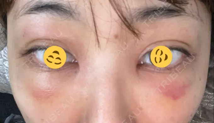 二重埋没 / クマ治療 / 上まぶたたるみ取り / 下まぶたたるみ取り MIL CLINIC OSAKA DAY 3 メイン用