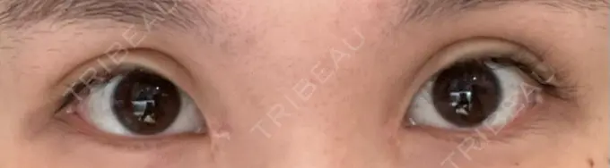 二重切開 / 蒙古ひだ形成 R.O.clinic DAY 14 メイン用