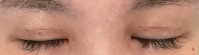 二重切開 / 蒙古ひだ形成 R.O.clinic DAY 14 メイン用