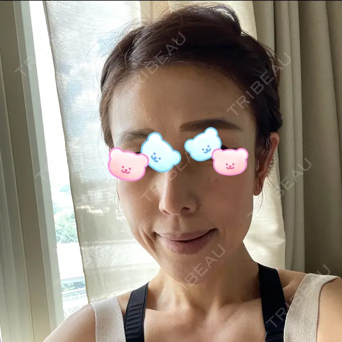 糸リフト / 脂肪吸引（顔） / 脂肪注入（肌） 湘南美容クリニック 秋葉原院 AFTER メイン用