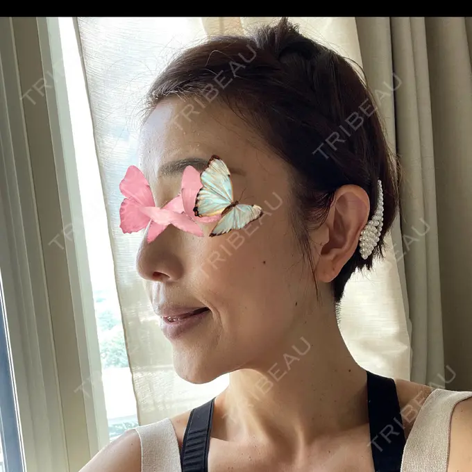 糸リフト / 脂肪吸引（顔） / 脂肪注入（肌） 湘南美容クリニック 秋葉原院 DAY 267 メイン用