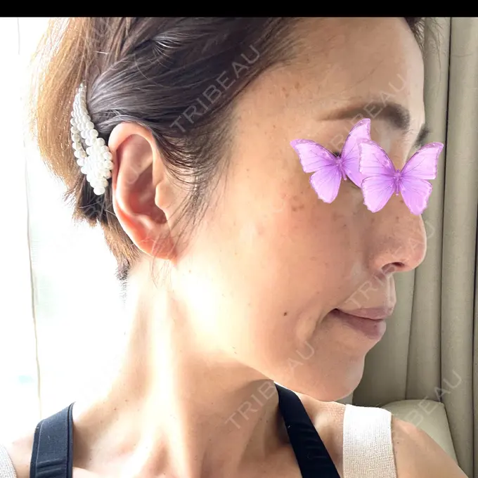 糸リフト / 脂肪吸引（顔） / 脂肪注入（肌） 湘南美容クリニック 秋葉原院 DAY 267 メイン用