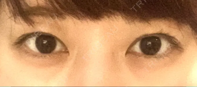 二重埋没 船橋中央クリニック DAY 33 メイン用