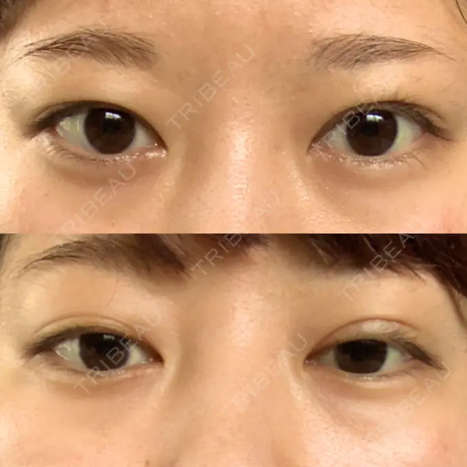 二重埋没 船橋中央クリニック DAY 34 メイン用