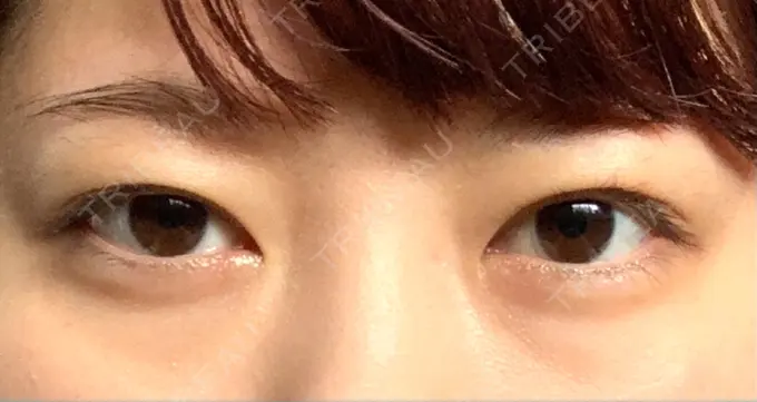 二重埋没 船橋中央クリニック DAY 35 メイン用