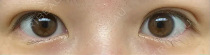 二重埋没 湘南美容クリニック 東京蒲田院 DAY 27 メイン用