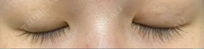 二重埋没 湘南美容クリニック 東京蒲田院 DAY 27 メイン用