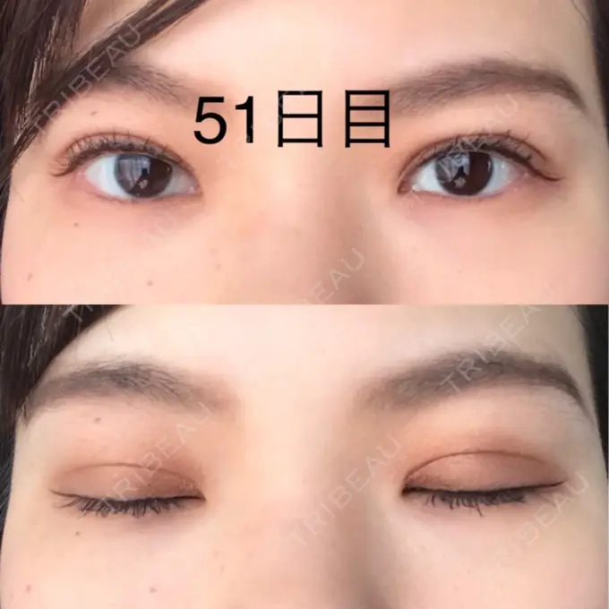 二重切開 / 上まぶたたるみ取り / 上まぶたの脂肪取り 城本クリニック 豊橋院 DAY 51 メイン用