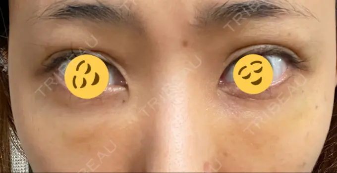 二重埋没 / クマ治療 / 上まぶたたるみ取り / 下まぶたたるみ取り MIL CLINIC OSAKA DAY 7 メイン用