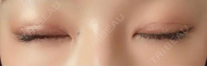 二重切開 湘南美容クリニック 藤沢院 DAY 31 メイン用