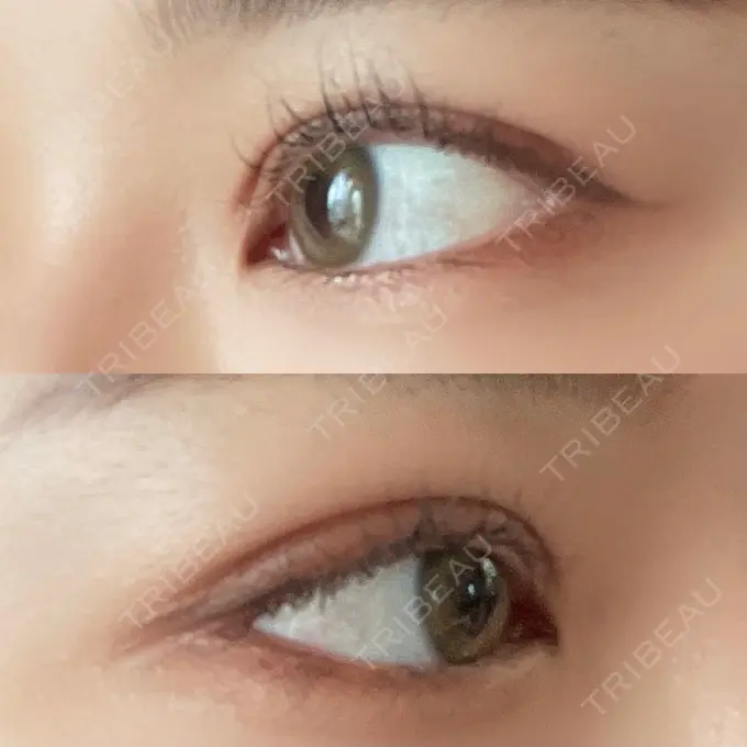 二重切開 湘南美容クリニック 藤沢院 DAY 31 メイン用