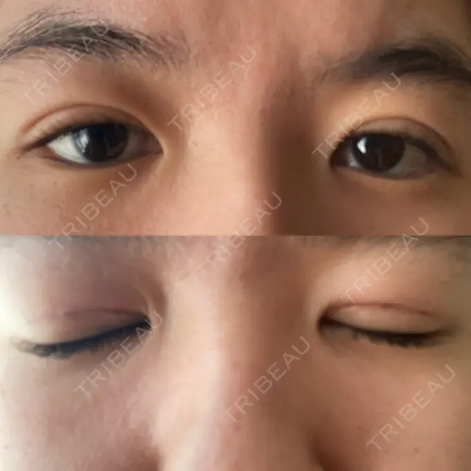 二重埋没 札幌ル・トロワ ビューティクリニックVogue DAY 1 メイン用