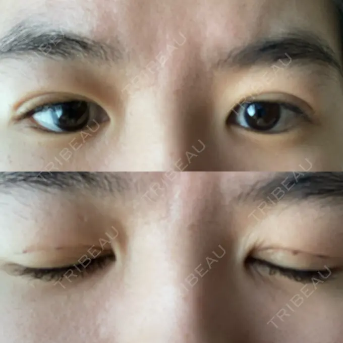 二重埋没 札幌ル・トロワ ビューティクリニックVogue DAY 2 メイン用