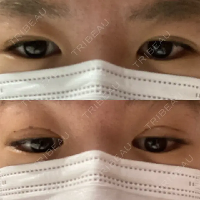 二重埋没 札幌ル・トロワ ビューティクリニックVogue DAY 3 メイン用