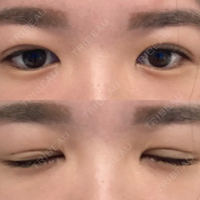 二重埋没 札幌ル・トロワ ビューティクリニックVogue DAY 4 メイン用